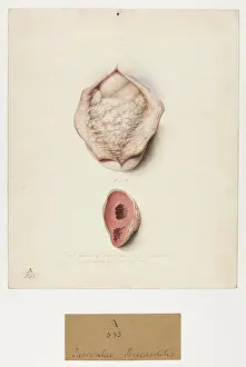 1831: Tubercular pericarditis