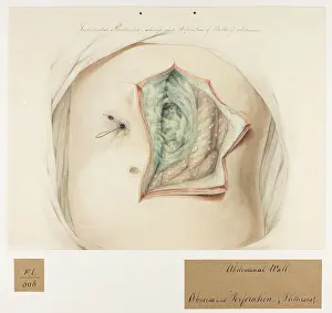 Perforation: Tubercular Peritonitis, Abscess, Perforation of the Abdomen