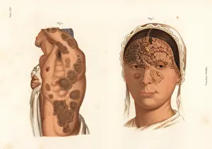 Bumstead: Tubercular syphilis symptoms on the body