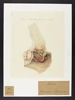 Termination: Tubercular Ulceration of the Termination of Ileon