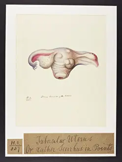 Rather: Tubercular Uterus, Scirrhus in Points