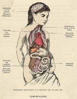 Sufferer: TUBERCULOSIS SUFFERER