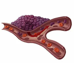 Carcinoma: Tumor Development, Illustration