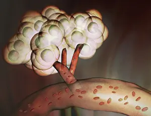 Carcinoma: Tumor, Illustration