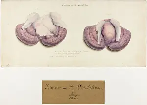 1827: Tumour in the cerebellum