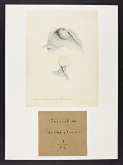 Tumour: Tumour: Dura Mater