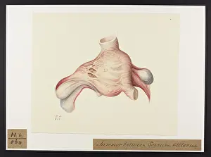 Tumour: Tumour: Sacrum and Uterus