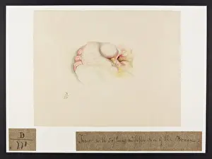 Blank: Tumour with Softening and Suppuration of Brain