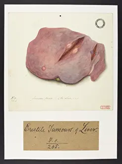 Liver: Tumours of the Liver