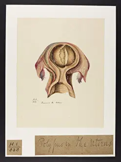 Tumours: Tumours in Uterus
