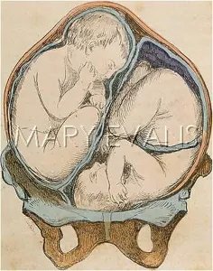 Foetus: TWINS IN THE WOMB