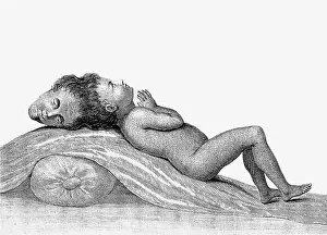 Deformity: Two-Headed Boy of Bengal, 1780s