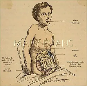 Typhoid: TYPHOID/DIAGRAM