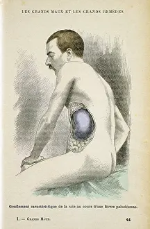 Obtained: Typical enlarged spleen of a Malaria patient