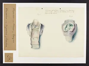 Ulceration: Ulceration and Abscess of Larynx