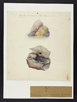 Ulceration: Ulceration & Aneurism of Aorta