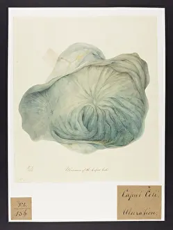 Ulceration: Ulceration of the Caput Coli