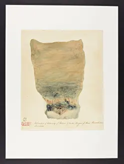 Ulceration: Ulceration, Extremity of Rectum, Anus, Haemorrhoidal Tumours