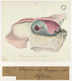 Ulceration: Ulceration and Gangrene of a part of the Spleen