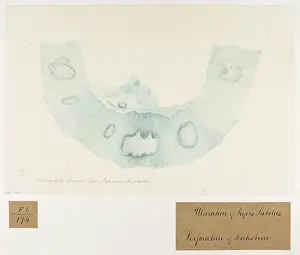 Ulceration: Ulceration of the Glandulae Peyeri