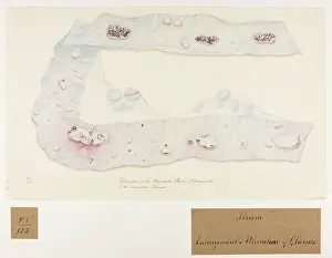 1826: Ulceration of the Glandulae Peyeri