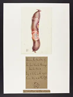 Ileum: Ulceration of the Ileum