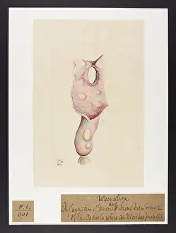 Ulceration: Ulceration, Inflammation - Mucous, Serous Membrane - Bowels