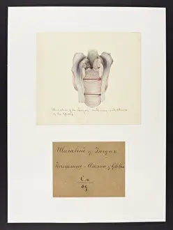 Ucl Library Services Digital Collections: Ulceration of the Larynx