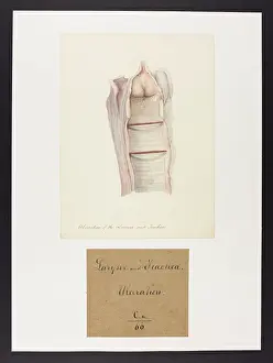 Ucl Library Services Digital Collections: Ulceration of the Larynx and Trachea