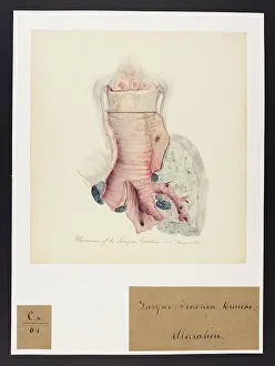 Ucl Library Services Digital Collections: Ulceration of the Larynx, Trachea and Bronchi