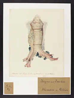 Ucl Library Services Digital Collections: Ulceration of the Larynx, Trachea and Bronchi