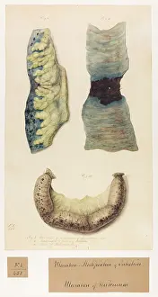 Mortification: Ulceration and mortification of intestine