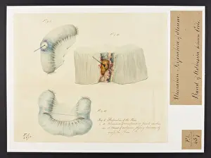 Coils: Ulceration and Perforation of Ileum