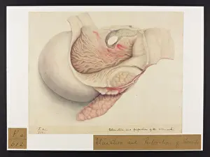 Hussey: Ulceration and Perforation of Stomach