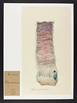 Ulceration: Ulceration of the Rectum