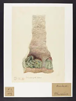 Ulceration: Ulceration of the Rectum