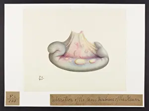 Blank: Ulceration of the Serous Membrane of the Ileum