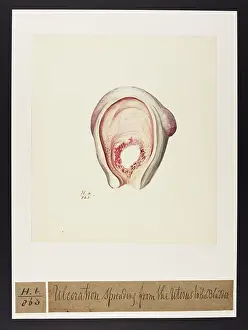 Spreading: Ulceration Spreading from Uterus to Bladder