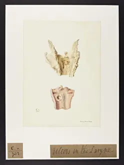 Ulcers: Ulcers in the Larynx