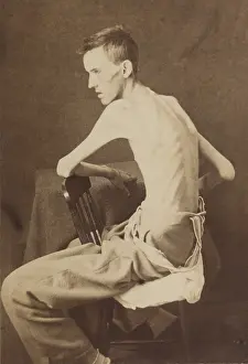 Emaciated: Union Private Jackson O. Brashears, as he