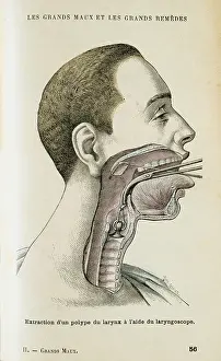 1805: Using a laryngoscope to aid a surgeon in the removal