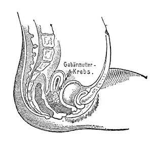 Cross Section: Uterine cancer, 1902