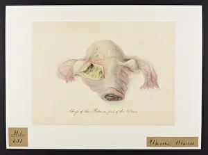 Uterus: Uterus: Abscess of Posterior Head