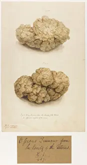 Tumour: Uterus: Bony Tumour from Cavity