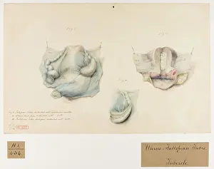 Femmes: Uterus and Fallopian Tubes: Tubercles