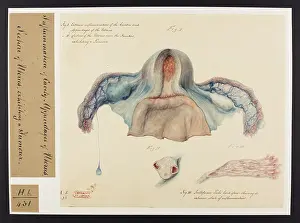 Femmes: Uterus and Fallopian Tubes: Tubercles