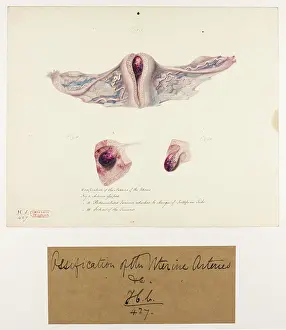 Novr: Uterus: Ossification of the Arteries