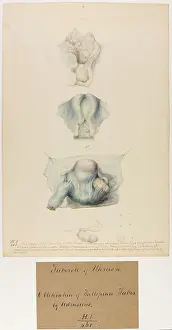 Tubes: Uterus: Tubercle, Obliteration of Fallopian Tubes