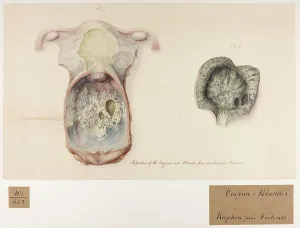 Perforation: Vagina and Bladder: Perforation from Mechanical Violence