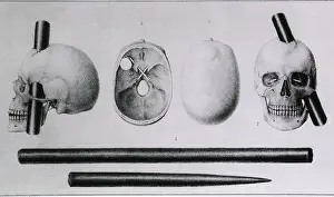 Brains: Various views of the famous wound in the ?
